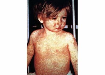 加拿大爆發逾年麻疹疫情　失去「無麻疹國」地位