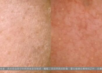 冬天洗臉越洗越乾?宋奉宜醫師:停止「熱水虐膚」,冷水才是修復敏感肌的關鍵