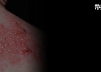 李雅芬建議輔助弱勢族群施打帶狀疱症疫苗  陳其邁同意研訂可行辦法