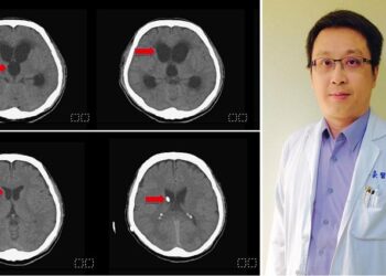 頭部外傷後意識不清嗜睡  留意水腦症  民生醫院團隊手術搶救  術後恢復意識重返職場