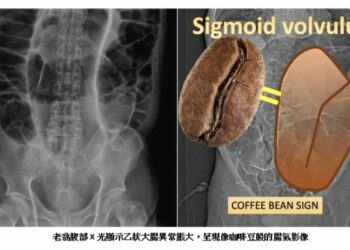 七旬老翁腹脹一週未排便　惡化腹痛就醫竟是大腸打結險喪命