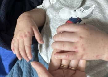 隱匿疫情恐觸法　高雄雙語小學腸病毒事件家長籲徹查