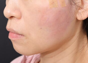 港女臉頰凹凸不平求助台灣 自體脂肪注射年輕化術回春圓夢