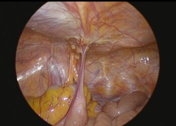 義大癌治療醫院癌症腹膜轉移 治療成果登上國際舞臺 多元整合治療經驗　展現醫療照護新進展