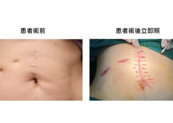 婦人腹部20公分「蜈蚣腳」白疤成噩夢 求救白疤之父獲救贖