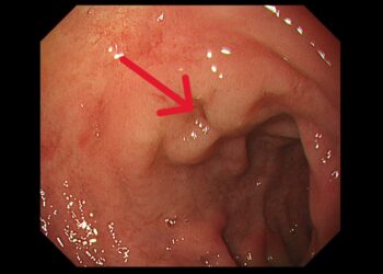從胃痛到確診第三期胃癌 義大醫療跨團隊陪患者與家屬走過治療關鍵期