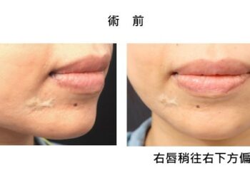 青春陰影臉部凸白疤如夢魘 白疤之父曹賜斌再生醫治重現昔日光采